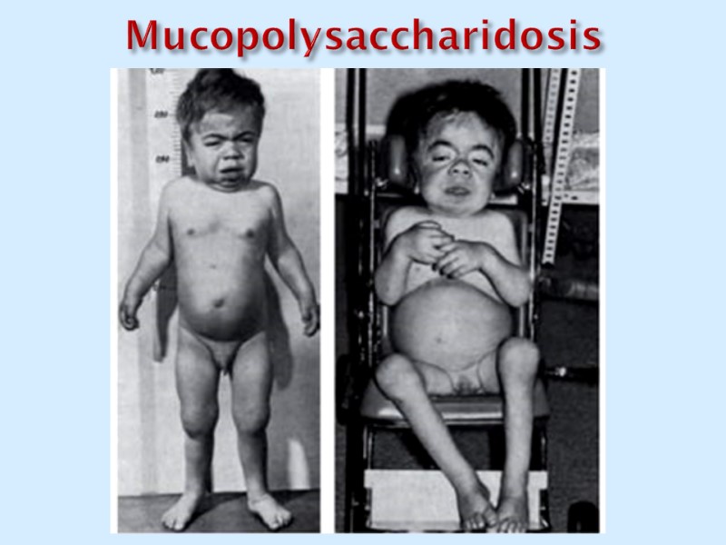 Mucopolysaccharidosis